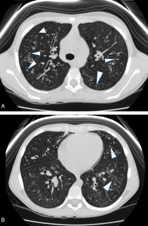 A y B) Valoración de la extensión de los tapones mucosos. Ambas imágenes pertenecen a un mismo paciente con afectación muy extensa en ambos pulmones. Se pueden observar tapones mucosos en la mayor parte de los segmentos mostrados (cabezas de flecha), totalizando un número superior a 9 (3 puntos Bhalla).