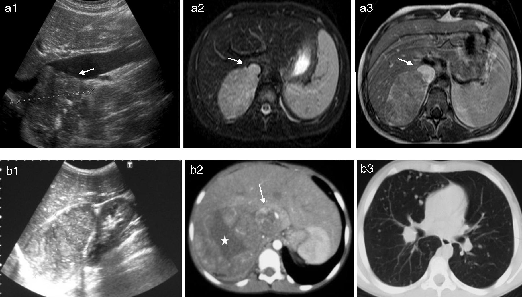 Tumores Corticosuprarrenales Pedi tricos Imagen De Adenomas Y Tumores Corticosuprarrenales Pedi tricos Imagen De Adenomas Y