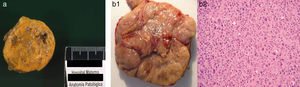 Anatomía patológica de un adenoma (caso 4) y un carcinoma (caso 7) corticosuprarrenal. a) Foto macroscópica de un adenoma, tumoración sólida bien delimitada, de pequeño tamaño (3 cm) y coloración amarillenta. b1-b2) Foto macroscópica de un carcinoma, tumoración sólida con áreas de necrosis y hemorragia, diámetro máximo de 9cm y peso de 160g. Foto microscópica (HE, x20), en esta zona de la neoplasia destaca la atipia citológica.
