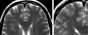Patrón vascular: migraña. En pacientes con migraña (generalmente con aura) es habitual hallar lesiones puntiformes frontales en la sustancia blanca subcortical que respetan a las fibras subcorticales en «U» (flechas).