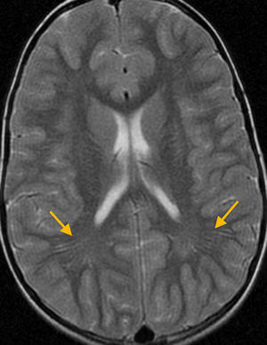 Niño de 5 años con cefaleas. Ver los espacios perivasculares dilatados es un hallazgo incidental, de dudosa-improbable trascendencia clínica.