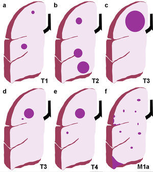 Ilustración de los cambios introducidos en la TNM-7; a) Categoría T1, con tumores T1a ≤2cm de eje mayor y T1b con eje mayor >2 y ≤3cm; b) Categoría T2, subdividida en T2a si el eje mayor es >3cm y ≤5cm, y T2b si es >5 y ≤7cm. Un tumor que invade la pleura visceral o atraviesa una cisura es un tumor T2; c) Categoría T3: cualquier tumor de más de 7cm de eje mayor; d) Categoría T3: nódulos tumorales separados en el mismo lóbulo que el tumor primario; e) Categoría T4: nódulos tumorales separados en un lóbulo diferente del pulmón ipsilateral, y f) Categoría M1a: metástasis intratorácicas como derrame pleural maligno, implantes pleurales y nódulos metastásicos en el pulmón contralateral (en la ilustración no aparece el tumor primario en el pulmón izquierdo).