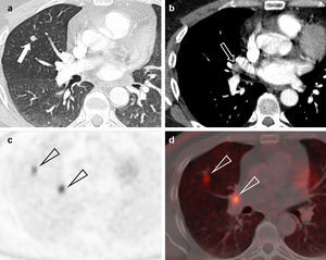 Adenocarcinoma de pulmón en un paciente de 45 años. (a) Imagen axial de tomografía computarizada multidetector (TCMD) torácica con contraste, ventana de pulmón, en la que se apreciaba un nódulo pulmonar solitario (flecha) bien delimitado en el lóbulo superior derecho de 7,2mm de eje mayor. (b) En la imagen axial de TCMD con ventana de mediastino no se observaron adenopatías, solo un ganglio aislado hiliar derecho de 8,3mm de eje corto (flecha). Por sus características, cumplía criterios para ser clasificado como un tumor cT1aN0M0 (estadio IA). Se realizó PET-TC. La imagen PET (c) mostraba dos depósitos patológicos (cabezas de flecha), con escasa resolución espacial. La fusión de imágenes PET-TC (d) permite una mejor caracterización de los hallazgos, y confirmó que los depósitos correspondían al nódulo y al ganglio visualizados en la TCMD (cabezas de flecha). Por tanto, este tumor se estadificó como cT1aN1M0 (estadio IIA).