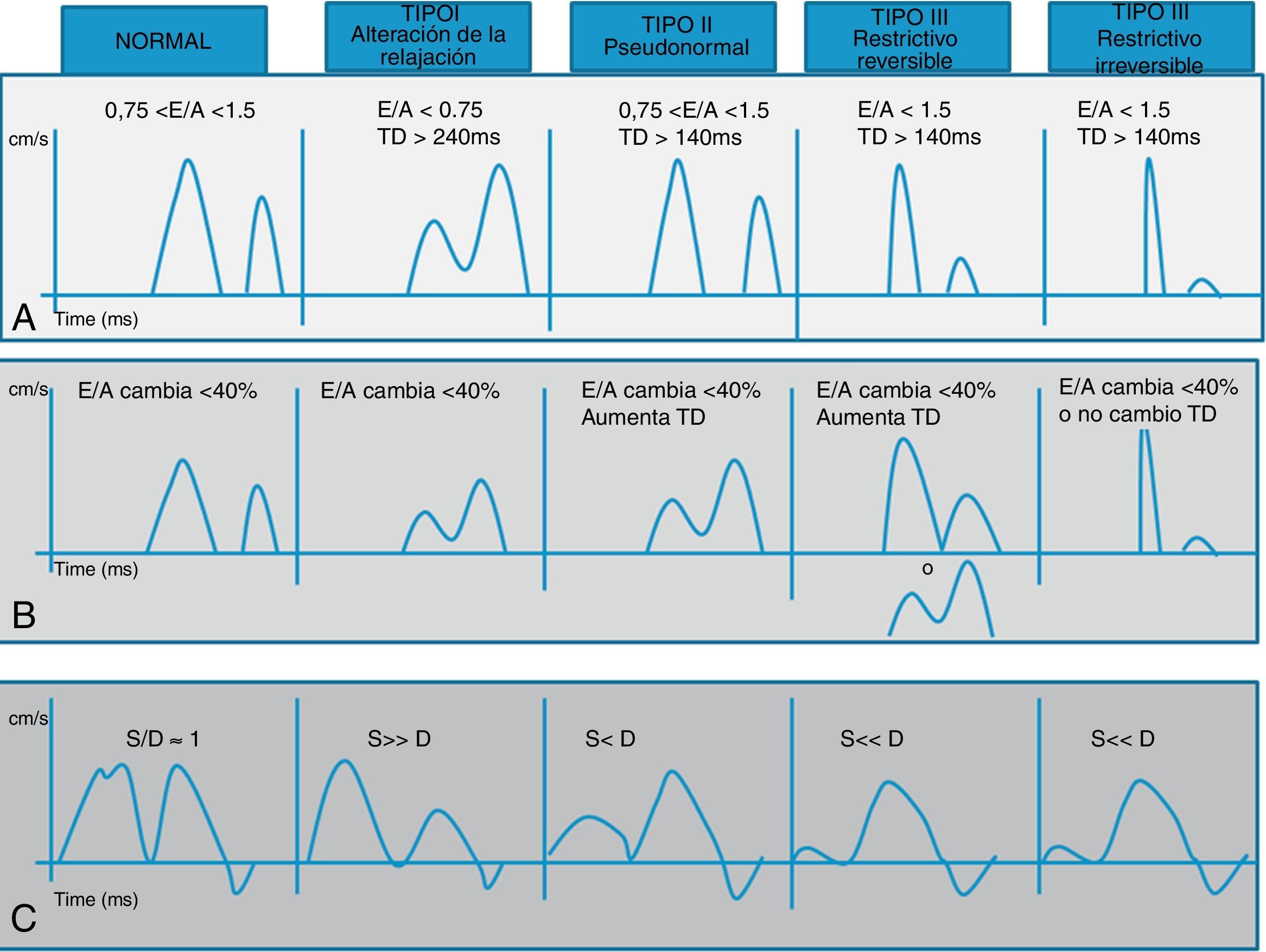 Normal Transmitral Inflow Pattern Análisis de la función diastólica del ventrículo izquierdo mediante ...