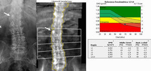 Absorciometría con rayos X de doble energía y radiografía simple en proyección AP en la columna (derecha). Aumento de densidad en el pedículo derecho L1 (flecha) que corresponde en la radiografía a un pedículo denso. La vértebra debe excluirse del análisis.