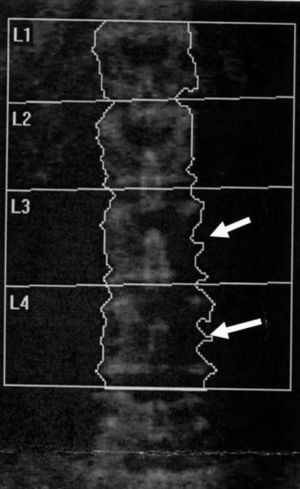 Absorciometría con rayos X de doble energía en la columna de un paciente con osteoporosis grave. La imagen simula un defecto en los cuerpos L3 y L4 (flechas), que no se confirmó las radiografías.