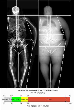 Estudio de absorciometría con rayos X de doble energía de cuerpo entero. El paciente sobrepasa el límite de la mesa por lo que el equipo analiza medio cuerpo (izquierdo) que se incluye totalmente y realiza una estimación del contralateral.