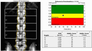 Imagen de absorciometría con rayos X de doble energía de columna lumbar PA. El estudio incluye los cuerpos vertebrales L1 a L4.