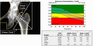 Imagen de absorciometría con rayos X de doble energía en la cadera izquierda. El trocánter menor no debe visualizarse. El área de análisis (ROI) se sitúa en el cuello femoral.