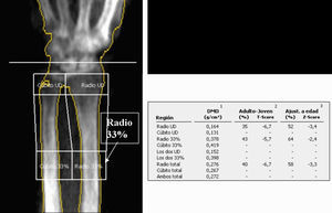 Imagen de absorciometría con rayos X de doble energía en el antebrazo. La línea de referencia se sitúa en la estiloides cubital.