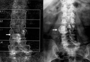 La imagen de la izquierda corresponde a una absorciometría con rayos X de doble energía en la columna. Imagen densa superpuesta al cuerpo vertebral L3 (flecha). En la imagen de la derecha, la radiografía simple de abdomen demuestra que corresponde a ganglio mesentérico calcificado (flecha).