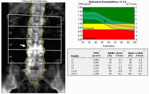Absorciometría con rayos X de doble energía en la columna. El aumento de densidad en la radiografía (flecha) corresponde a una esclerosis de los platillos L3 y L4. En al análisis, la densidad mineral ósea (DMO) en L3 y L4 es mayor que en L1 y L2. Al excluir ambas vértebras T-score L1-L2=-1,9 (L1-L4=-0,5).