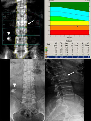 Arriba, absorciometría con rayos X de doble energía en la columna. Aumento de densidad del cuerpo vertebral L2 (flecha) que, en las radiografías de abajo, corresponde a una fractura (flecha). En las dos exploraciones también se identifica una calcificación (cabezas de flecha) no superpuesta a la columna (no altera el análisis).
