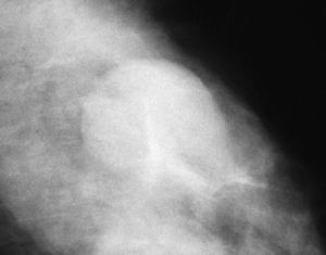 Nódulo en la mamografía, de morfología ovalada y márgenes ocultos, clasificado como subcategoría BI-RADS®4A.