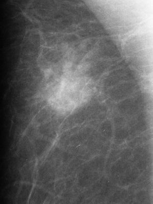 Nódulo en la mamografía de morfología redondeada y margen mal definido, clasificado como BI-RADS®4A.