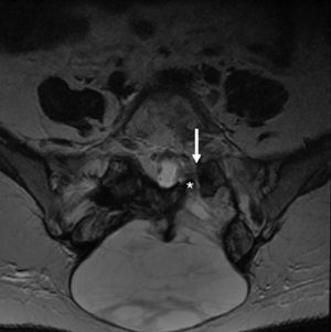 Pseudomeningocele. Paciente mujer de 36 años de edad intervenida por hernia discal L5-S1. Imagen de RM posquirúrgica con secuencia potenciada en T2 axial donde se visualiza un pseudomeningocele posquirúrgico en el lecho de la laminectomía izquierda S1 (flecha). La sensibilidad de la RM es mayor que la de cualquier otra prueba de imagen y puede visualizarse la comunicación de la lesión con el saco tecal (asterisco).