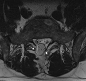 Hallazgos normales tras la cirugía de columna lumbar. Paciente varón de 40 años, intervenido de laminectomía L5-S1 derecha. En la RM posquirúrgica con corte axial potenciado en T2 se observa el saco dural herniado a través del segmento de la laminectomía (flechas).