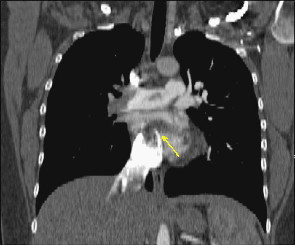 Obval Maxima Tromboembolismo pulmonar agudo masivo con trombo atrapado en foramen ...