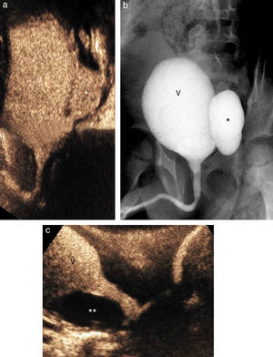 Afección vesical. Divertículo vesical en un paciente de 4 años de edad con antecedente de infecciones del tracto urinario de repetición, reflujo vesicoureteral (RVU) grado II al riñón izquierdo y divertículo paraureteral. Imagen compuesta de la urosonografía miccional seriada (UMS) de control donde se observa un divertículo de Hutch (*) con RVU grado II al riñón izquierdo (a). La imagen se correlaciona muy bien con la de la cistouretrografía miccional seriada (b). Ureterocele en un lactante de un mes fruto de un embarazo no controlado. En el transcurso de un ingreso por crisis de apnea se hizo un estudio abdominal con el que se observó una duplicidad renal bilateral con ureterohidronefrosis y ureterocele derecho. Con la UMS se observó un defecto de repleción ovalado intravesical correspondiente al ureterocele (**) (c). Vejiga (V).