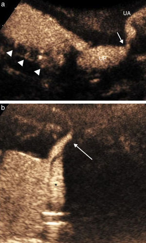 Afección uretral. Válvulas de uretra posterior en un recién nacido con antecedente prenatal de oligoamnios y ureterohidronefrosis de alto grado bilateral. Con la urosonografía miccional seriada (UMS) se observaba una vejiga de lucha que se caracterizaba por un engrosamiento e irregularidad de la pared y divertículos (cabezas de flecha), una dilatación de la uretra posterior (UP)>7mm, sin distensión del área valvular (flecha), con dificultad en la progresión del contraste, y una disminución del calibre de la uretra anterior (UA) (a). Divertículo del utrículo prostático en un lactante de 4 meses de edad con hipospadias escrotal dentro del síndrome de WARG. La UMS con abordaje transperineal interescrotal demuestra una imagen sacular, dependiente de la cara posterior de la uretra posterior (flecha), que correspondía a un divertículo del utrículo prostático (*) que se llenaba homogéneamente durante la fase de repleción intravesical (b).