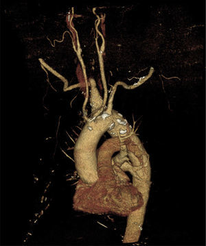 Reconstrucción volumétrica 3D volume rendering (VR) que muestra un arco aórtico izquierdo con origen común de las arterias carótidas comunes y arteria subclavia derecha aberrante. La arteria subclavia derecha aberrante se origina de un divertículo de Kommerell.