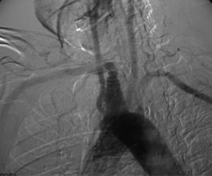 Aortografía torácica con sustracción digital en proyección oblicua izquierda en la que se observa arco aórtico izquierdo con arteria subclavia derecha aberrante que se origina de un divertículo de Kommerell.
