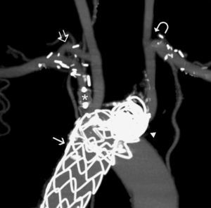 Control mediante TC tras tratamiento híbrido. La proyección de máxima intensidad (MIP) desde una visión posterior muestra la endoprótesis (flecha), un puente carótido-subclavio izquierdo (flecha abierta) y reimplantación de arteria subclavia derecha en la carótida común derecha (flecha curva), permeables. Embolización del divertículo de Kommerell mediante espirales (cabeza de flecha) y del segmento proximal de la arteria subclavia izquierda mediante tapones vasculares Amplatzer (asterisco).
