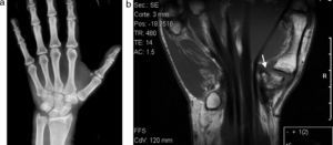 Radiografía AP de muñeca (A) y RM de muñeca, coronal T1 (B). Línea de fractura en el hueso trapecio (flecha), no visible en la radiografía convencional.