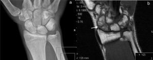 Radiografía AP de muñeca (A) y RM de muñeca coronal T1 (B). Línea fractura en el hueso escafoides (flecha en B), no visible en la radiografía convencional.