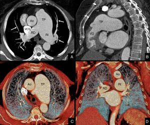 Estudio cardiotorácico con sincronización ECG de un paciente varón de 48 años, con hipertensión pulmonar. El estudio vascular (A y B) mostró una dilatación del tronco principal (TP) y de las ramas izquierda (RI) y derecha (RD) de la arteria pulmonar, con disminución significativa del calibre y afilamiento de ramas segmentarias (flechas). Las reconstrucciones volumétricas con mapa de colores (C y D) mostraron la disminución de la vascularización pulmonar secundaria a la hipertensión del paciente.Ao: aorta; VCS: vena cava superior; VD: ventrículo derecho.