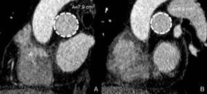 Estudio cardiotorácico sincronizado con ECG del mismo paciente varón de 48 años, con hipertensión pulmonar de la figura 3. Estudio de distensibilidad de la arteria pulmonar. Imágenes seccionales de la rama derecha de la arteria pulmonar. A) Imagen sistólica. B) Imagen diastólica. Nótese que el área de la rama pulmonar derecha en sístole (7,9 cm2) es muy similar al área medida en diástole (6,96 cm2), signo sugestivo de hipertensión pulmonar.