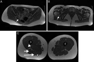 Músculos inervados por el nervio ciático. A) Músculo piriforme (flecha). B) Músculo cuadrado femoral (flecha). C) Músculos grácil (asterisco pequeño), cabeza corta del bíceps femoral (cabeza de flecha), cabeza larga del bíceps (flecha corta), semimembranoso (asterisco grande) y semitendinoso (flecha larga).