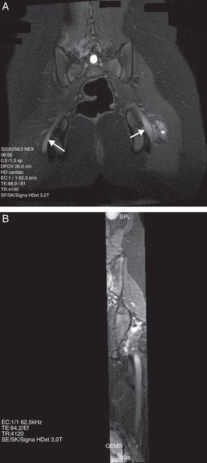 Niña de 13 años con antecedente de cirugía en posición sentada durante 8h. A) Secuencia IDEAL ponderada en T2 con saturación de la grasa en el plano coronal. Se observa un aumento de la señal y engrosamiento difuso de ambos nervios ciáticos, con predominio en el lado izquierdo (flecha). Se acompaña de edema de las partes blandas adyacentes en el lado izquierdo (asterisco). B) Reconstrucción MPR curva en el eje longitudinal del nervio.
