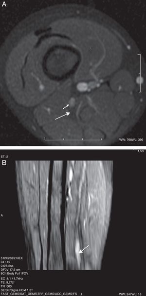 Niño de 4 años con marcha polineurítica de un año de evolución, con EMG compatible con lesión del nervio peroneo. A) Secuencia SPGR ponderada en T1 con saturación de la grasa e inyección de gadolinio. Muestra un nódulo en la división peronea del nervio ciático (flecha corta). Por detrás se observa la división tibial con un patrón fascicular normal (flecha larga). B) Reconstrucción MPR curva donde se observa el engrosamiento fusiforme en el tercio distal del nervio ciático (flecha).