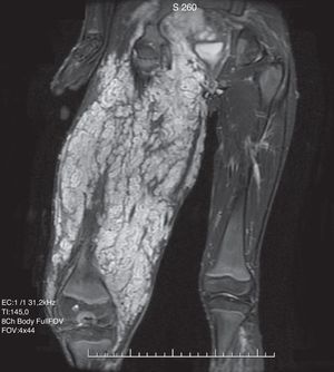 Niño de 14 años, con antecedente de neurofibromatosis tipo I. Secuencia SSFSE ponderada en T2 en el plano coronal del muslo, en la que se observa una formación voluminosa en las partes blandas del muslo, con alta intensidad de señal, polilobulada, con múltiples septos. La biopsia demostró un neurofibroma plexiforme del nervio ciático.