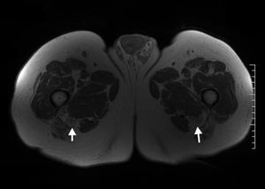 Paciente de 73 años que presentaba parestesias leves en el territorio peroneo de ambos lados. En las imágenes ponderadas T1 se observa aumento de grosor del nervio ciático de ambos lados a expensas de una hipertrofia del componente graso intraneural, hallazgo compatible con lipomatosis bilateral del nervio ciático (flecha).