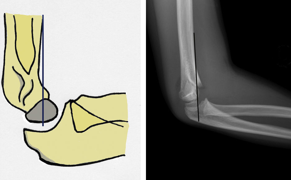Radiología de las fracturas: algo más que un trazo | Radiología
