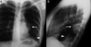 Radiografía simple de tórax de la segunda paciente. Proyección posteroanterior (A) y lateral (B), que muestra dos masas en el hemitórax izquierdo con base en la pleura costal posterior (flecha) y en la pleura diafragmática (punta de flecha).