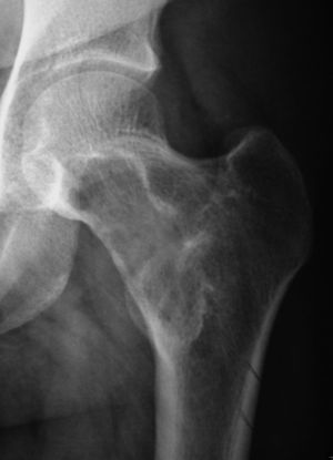 Radiografía simple en proyección anteroposterior, centrada en el fémur proximal izquierdo. Lesión osteolítica con bordes reforzados de aspecto esclerótico localizada en la parte medial del cuello y región intertrocantérea del fémur.