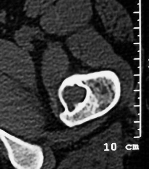 Imagen axial de tomografía computarizada a la altura del trocánter menor del fémur. Lesión no mineralizada, con alguna trabécula fina en su interior, y borde escleroso ancho. La lesión no ocupa toda la cavidad medular femoral. En este corte, el grosor de la cortical está respetado.