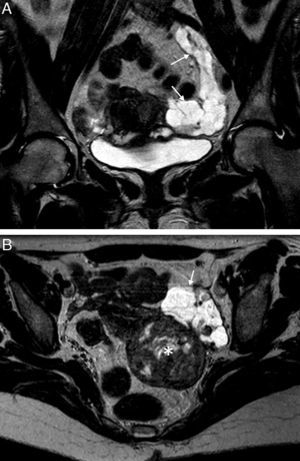 Linfangioma quístico. Mujer de 47 años diagnosticada por ecografía transvaginal de masa quística anexial izquierda. A) T2 TSE coronal, y B) T2 TSE axial. Masa en la región anexial izquierda, multiquística, seudotubular, con septos completos en su interior, que rodea a los vasos ilíacos (flecha). En el plano coronal se muestra la extensión craneal de la masa. El diagnóstico se confirmó con la cirugía. Mioma uterino en la pared posterior (*).