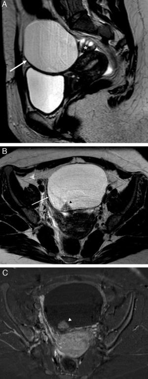 Neoplasia de trompa. A) T2 TSE sagital; B) T2 TSE axial, y C) imagen de sustracción de T1 TSE con y sin contraste iv. Lesión quística redonda –no tubular– (flecha), mayor de 10cm, adyacente al ovario (* en A), pero que no depende de él. Polo sólido de aspecto papilar (cabeza de flecha) dependiente de la pared, hipercaptante que corresponde a un tumor seroso proliferativo atípico de la trompa.