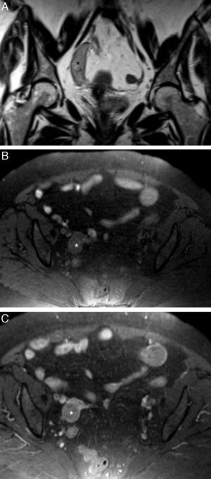 Neoplasia tubárica primaria derecha (adenocarcinoma endometrioide). Mujer de 73 años con pequeños sangrados (spotting) sin elevación de marcadores tumorales. A) T2 TSE coronal; B) T1 TSE axial con supresión grasa (SG), y C) T1 TSE axial SG con contraste iv. Masa sólida tubular en la región anexial derecha (*), heterogénea en las secuencias T2. En T1 TSE SG la masa muestra una señal mayor que el músculo y realza de forma moderada y heterogénea tras la inyección iv de contraste paramagnético. Ovarios atróficos.