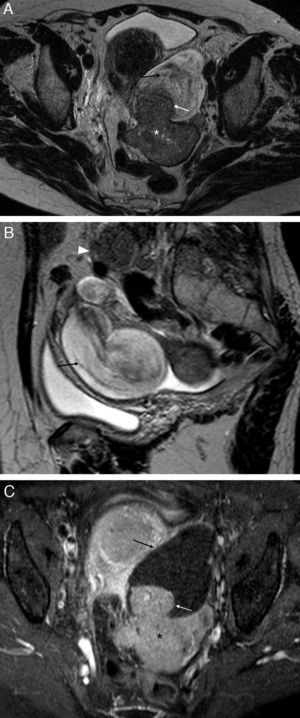 Neoplasia ovárica izquierda con invasión secundaria de la trompa ipsilateral. Mujer de 66 años con marcadores tumorales elevados. A) T2 TSE axial; B) T2 TSE sagital, y C) T1 TSE axial con saturación grasa (SG) con contraste iv. Masa sólida anexial izquierda (*) que realza con contraste, que correspondía a un cistoadenocarcinoma seroso papilar de ovario. Se extiende a la región ampular de la trompa ipsilateral (flechas blancas) a la que obstruye y dilata (flechas negras). Se acompaña de grandes adenopatías regionales (cabeza de flecha).
