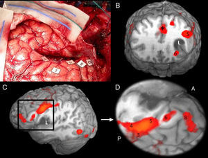 Correlación cortical entre la RM funcional y el mapeo eléctrico quirúrgico en el mismo paciente de la figura 4. A) Mapeo intraoperatorio. Paciente en decúbito lateral derecho. 4: Córtex facial motor; 3: córtex premotor; 5, 6: área de Broca; 8: eye field frontales. Correlación con la RM funcional (B, C y D): áreas de activación coincidentes con el mapeo cortical. *Área motora suplementaria. A: anterior; P: posterior.