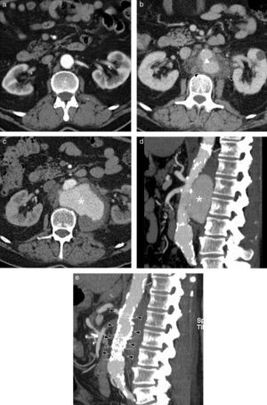 Aneurisma micótico en un varón de 70 años con lumbalgia y febrícula. TC con contraste intravenoso: a) Imagen axial que muestra una aorta de paredes normales; b) masa de partes blandas periaórtica (cabezas de flecha), afectando al ostium de la arteria mesentérica superior y de las arterias renales (el mismo paciente, un año después de la imagen a). Imagen axial de TC con contraste (c) y reconstrucción MIP sagital (d), que muestran un aumento del tamaño del aneurisma (asterisco), con paredes muy irregulares (meses más tarde que la imagen b). e) Imagen MIP sagital de TC con contraste después del tratamiento con una endoprótesis aórtica Endurant 25mm×70mm (cabezas de flecha), por el elevado riesgo de rotura del aneurisma.