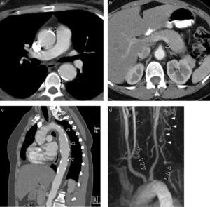 Arteritis de Takayasu en mujer de 34 años. a) Imagen axial de TC con contraste que muestra dilatación e importante calcificación de las paredes de la aorta torácica ascendente y descendente (cabezas de flecha). b) Corte axial de TC con contraste. Engrosamiento de la pared de la aorta abdominal y del ostium de la arteria mesentérica superior (cabeza de flecha). c) Reconstrucción MPR sagital. Irregularidad parietal (cabezas de flecha) y extensa calcificación de la aorta. d) Reconstrucción MIP coronal de angio-RM de troncos supraaórticos. Oclusión completa de ambas arterias subclavias en sus porciones prevertebrales (cabezas de flecha negras) con recanalización posterior en el lado izquierdo por arterias cervicales (cabezas de flecha blancas) y en el lado derecho por la arteria vertebral (flecha).