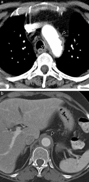 Arteritis de células gigantes en una mujer de 72 años con cefalea y claudicación mandibular. Estudio de TC con contraste que muestra engrosamiento (cabezas de flecha) de la pared del cayado aórtico (a) y de la aorta abdominal (b).