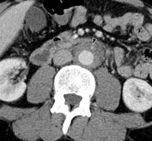 Fibrosis retroperitoneal en un varón de 47 años con dolor abdominal y pérdida de peso. Imagen axial de TC con contraste que muestra un engrosamiento de la pared de la aorta abdominal y tejido adyacente de densidad de partes blandas que engloba a la arteria mesentérica inferior (cabeza de flecha).