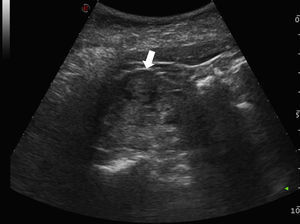 Nódulo cortical renal sólido pequeño (flecha) detectado incidentalmente en la ecografía de un paciente sin síntomas urológicos. Es actualmente la forma más frecuente de presentación del carcinoma de células renales.